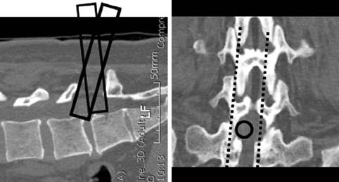 대한척추외과학회지 Vol. 14, No. 3, 2007 Fig. 8. Sagittal (A) and coronal (B) reformatting images of the CT scan show the enough interlaminar space at L5-S1. 다 9,10).