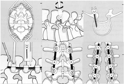 척추경나사기기 1980 년대유럽에서개발 척추의교정과유합을위한기기로사용이급증 척추경나사 (pedicle screw) 의인정기준 (2008 년 1 월 1 일시행 ) 가.