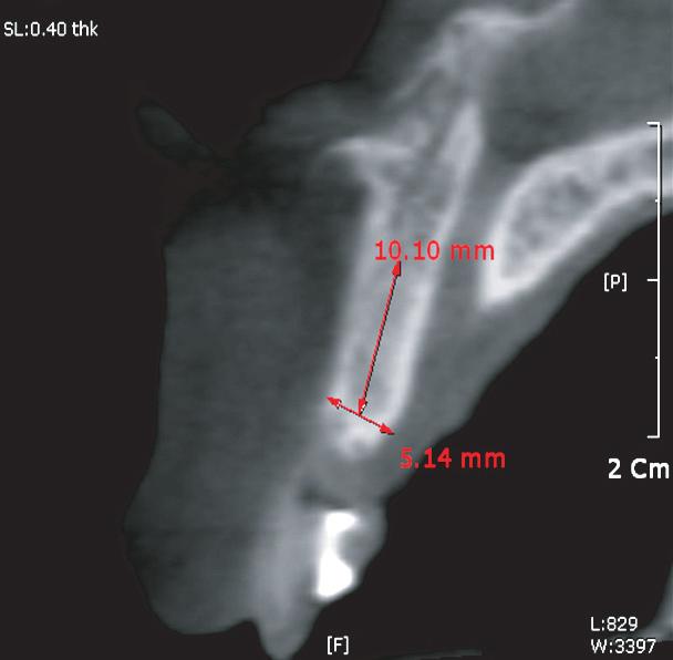 치근단방사선사진을통한계측결과인접면접촉점과치조골과의 거리는 6 mm 이상이었으므로향후치간유두가차오르지않고 black