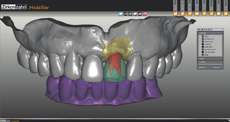 model and opposite dentition. Fig. 14.