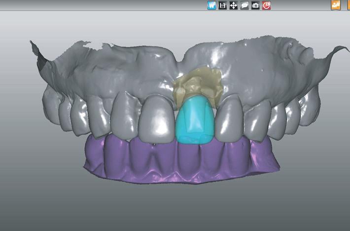 two-piece internal implant-abutment