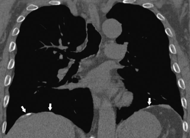 Diaphragmatic pleural plaques. Coronal reformation CT image shows bilateral calcified and non-calcified diaphragmatic pleural plaques.