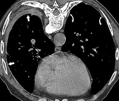 Diffuse pleural thickening: CT image in a patient with previous asbestos exposure shows diffuse pleural thickening