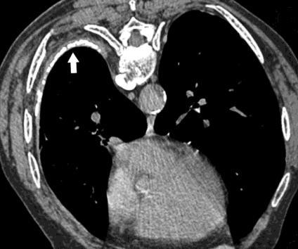 CT image obtained 6 years later shows extensive calcification (arrow) of the diffuse pleural thickening.