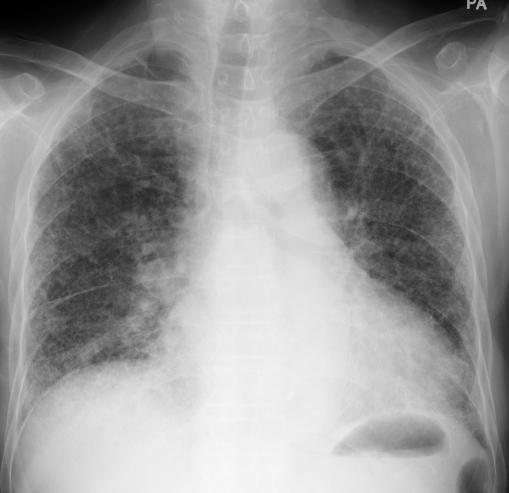 Asbestosis: Eextensive bilateral (ground-glass opacities) mainly in the lower lobes The