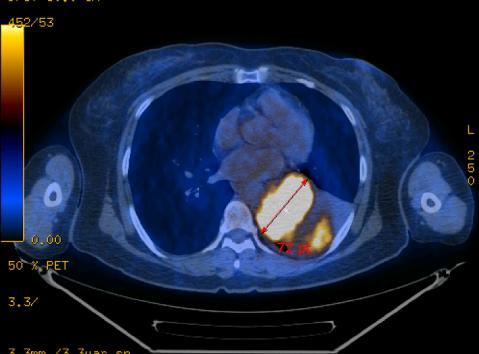 CT PET-CT 석면관련질환 양성 1) 흉막비후 - 흉막반