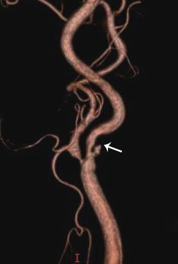 In a 67-year-old woman patient, MRI shows focal stenosis at the right carotid bulb and complete occlusion