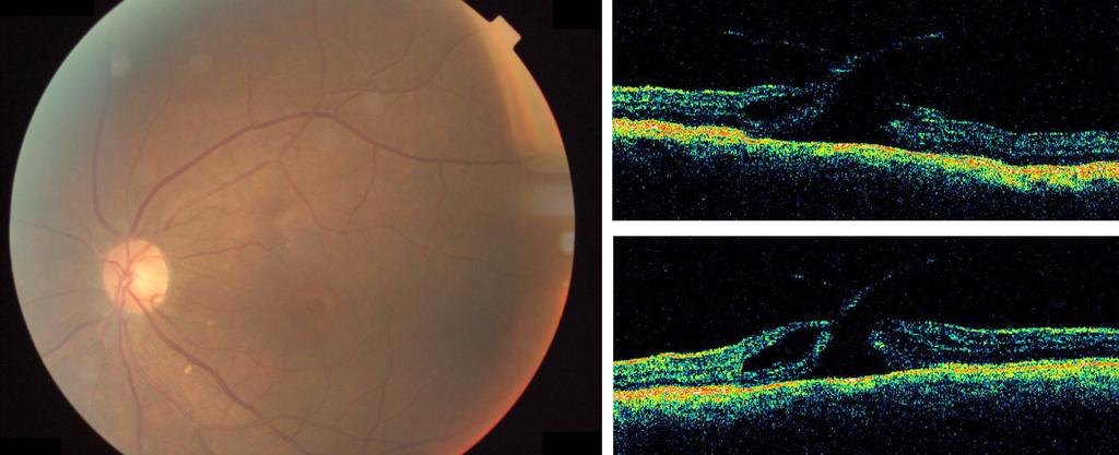 - 대한안과학회지 2010 년제 51 권제 6 호 - A B C Figure 1. Fundus photograph (A) and horizontal (B) and vertical (C) opitical coherence tomography (OCT) images reveal a stage 2 macular hole before surgery.
