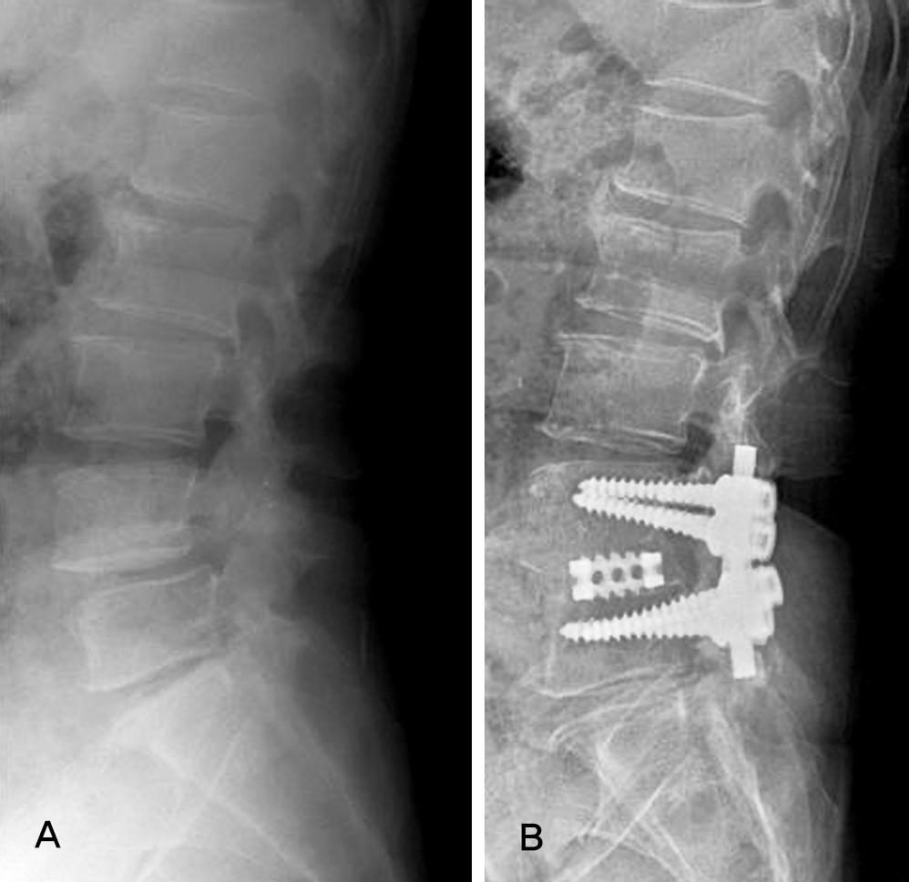 Journal of Korean Society of Spine Surgery Restoration of Lumbar Lordosis with Cage Table 2. Change of segmental lordosis Preop Postop Final Preop-PO Preop-final PO-final Segmental lordosis L34 5.0 5.