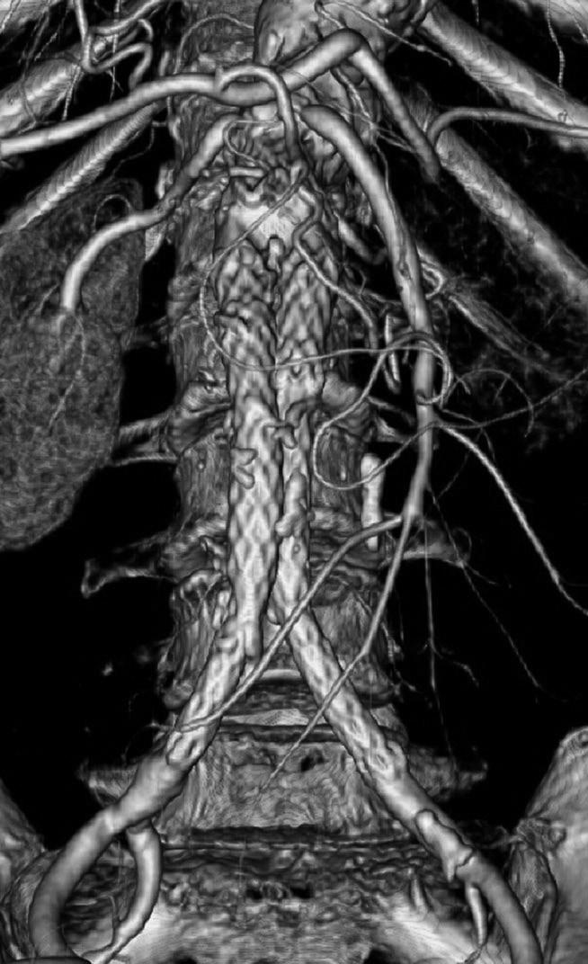 Volume-rendering CT image showed no endoleak on 5 days of the placement of aortic stent-graft. D.