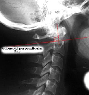Full Spine Technique Protocol (Diagnosis) X-ray check ( 영상분석 ) 경추 (Cervical) : Lateral - Cervical Odontoid