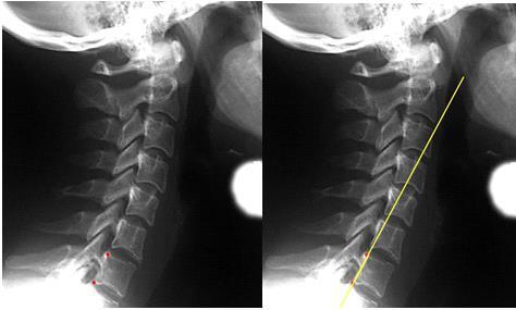 Full Spine Technique Protocol (Diagnosis) X-ray check ( 영상분석 ) 경추 (Cervical) : Lateral - Cervical Stress angle 그림과같이경추