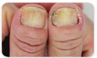 14 표적치료에대한이해표적치료제는어떤부작용이있고어떻게대처하나요? 2) 손발톱주위염 손발톱주위염이란손톱이나발톱주위의피부나손발톱자체에발생한염증입니다. 발톱특히엄지발톱이나양쪽손톱끝이피부안으로파고들어가염증을유발하는증상으로표적치료제를사용한지몇주또는몇달후에발생하며약복용을중지해도몇주또는몇달동안지속될수있습니다. 손가락보다는발가락에더많이생깁니다.