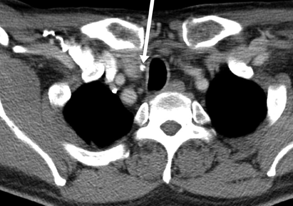 Histopathological analysis revealed a metastatic papillary carcinoma. US = ultrasonography Fig. 3. US image of a 66-year-old male with papillary thyroid carcinoma.