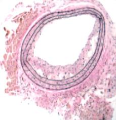 하연수박희권 A B C D Figure 4. Animal model. (A) Primary lesion, (B) immediately post-angioplasty, (C) neointimal hyperplasia at 3 weeks later, and (D) plaque after 3 month of intervention.