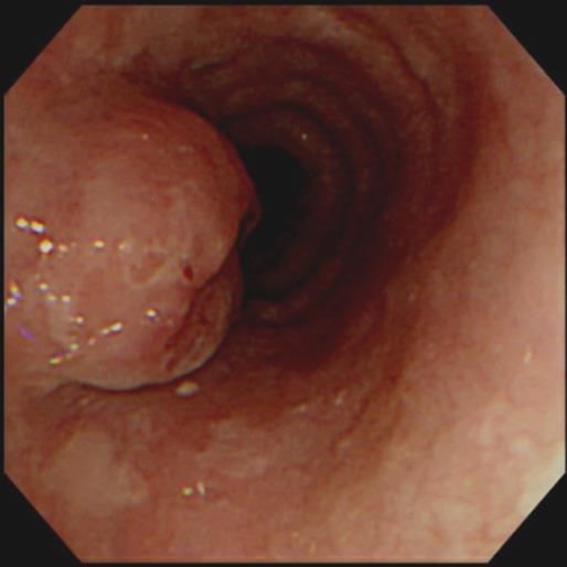 Esophageal cancer s/p STG for EGC (M/70) 2002. 5. 20. Subtotal gastrectomy Adenocarcinoma (W/D), intestinal type 1.6x1.