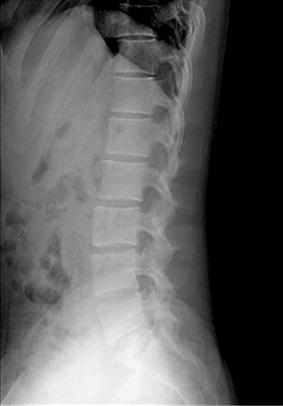 대한류마티스학회지제 15 권제 3 호 2008 Fig. 2. (A) Anteroposterior radiograph of the pelvis showing multiple periarticular erosions and sclerosis of both sacroiliac joints.