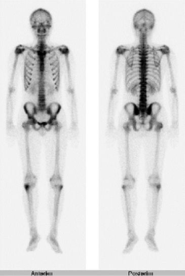 과거력및사회력 : 학생가족력 : 특이사항이없었다. 신체검사소견 : 두경부와흉복부소견에서특이소견이없었다. 오른쪽고관절내회전시, 오른쪽슬관절굴곡시통증이있었으나슬관절의부종이나압통은없었다. 척추운동장애검사에서뒤통수와벽사이가 0 cm, 흉곽팽창 3 cm, 쇼버검사는 5 cm 팽창을보였다. 검사실소견 : 일반혈액검사에서백혈구 8,000/mm 3 ( 호중구 74.