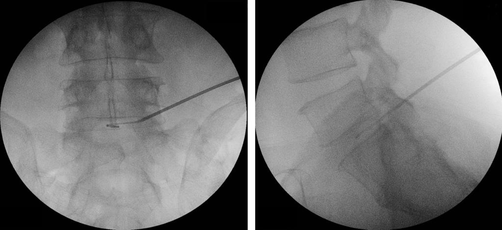 Journal of Korean Society of Spine Surgery Nucleoplasty for Lumbar Disc Herniation A B Fig. 2. Fluoroscopic images, with the guide needle placed at the center of the intervertebral L4-L5 disc.