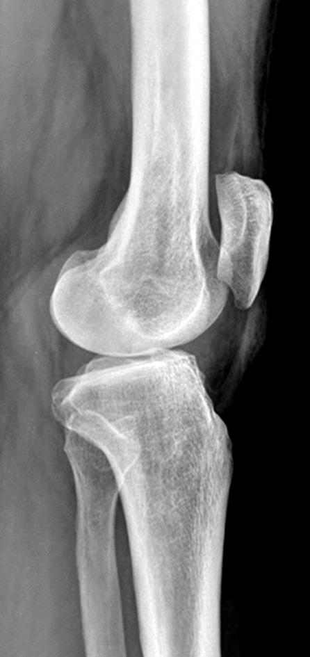 392 Fig. 1. Preoperative radiographs of a 54-year-old male showing genu varum with medial compartment osteoarthritis.