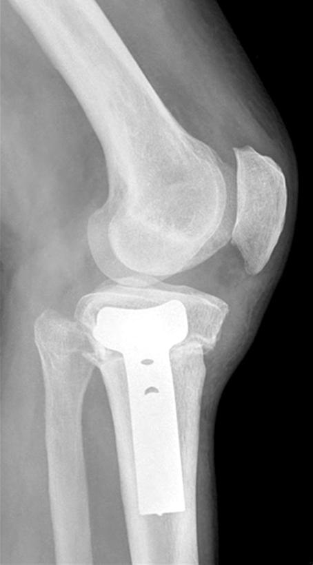뒤쪽 의 피질골 일부 및 골막을 보존하여 절골부를 개방할 때 Fig. 2.