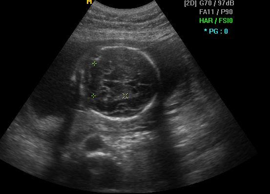 임신 16주 5 일에삼중표지자검사(triple test) 를시행했고, 6일후인 임신 17주 4일에결과는에드워드와다운증후군에서는 저위험군소견이었으나 AFP은 으로신경관결손증에양성소견나왔다. 367 IU/mL(10.