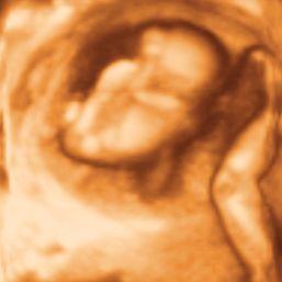 내진에서자궁경부는 dead fetus dead fetus live fetus 6cm 개대에 80% Fig. 3. 3D ultrasound at 22+4 weeks gestation showing 14+3 weeks' dead fetus and normal leg of live fetus. 의소실을보였고, 골반에진입한상태였다.