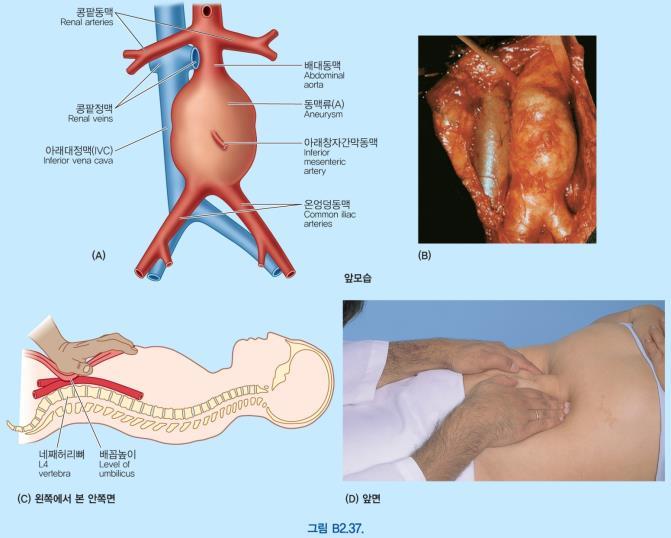 배대동맥류 (abdominal aortic aneurysm): 선청성이나후천성으로대배동맥벽이약해져대동맥이국소적으로커진경우
