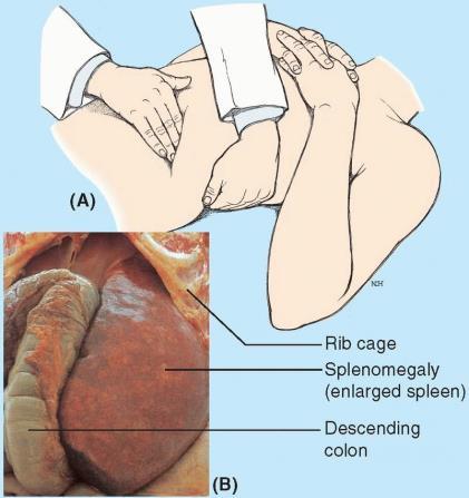 If ruptured, the spleen bleeds profusely because its capsule is thin and its parenchyma is soft and pulpy. Rupture of the spleen causes severe intraperitoneal hemorrhage and shock.