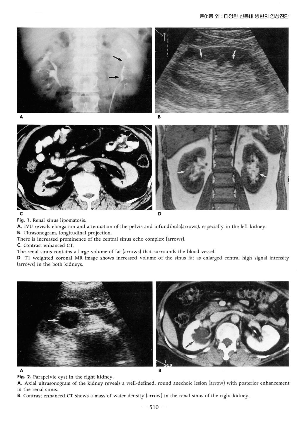 윤여동오 1: 다암한신동내병변의영상진단 c D Fig. 1. Renal sinus lipomatosis.. IVU reveals elongation and attenuation of the pelvis and infundibula{arrows), especially in the left kidney.