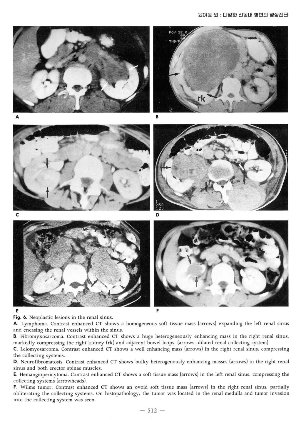 윤여동오 1: 다앙한신동내병변의영상진단 c D E F Fig. 6. Neoplastic lesions in the renal sinus.. Lymphoma.