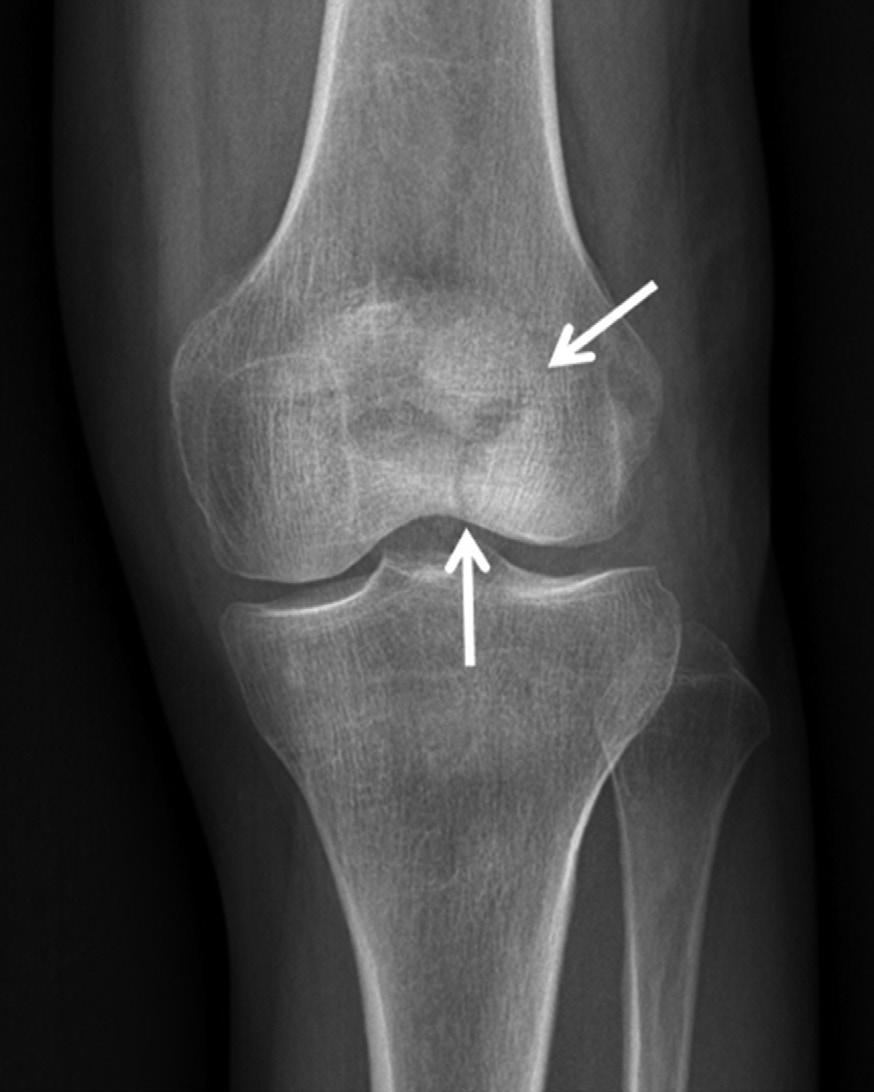 한석외 Fig. 16. Patellar complex fracture. complex fracture (arrows) is seen on anteroposterior () and lateral () radiographs.