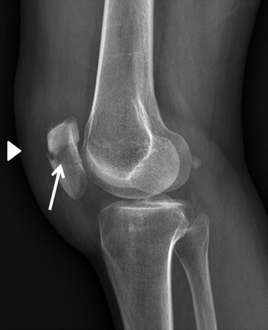 단순촬영에서는외측경골고평부외측면에골편 (bone fragment) 이관찰된다. Segond 골절이있을경우전방십자인대 (anterior cruciate ligament) 손상의가능성이높다 (Fig. 17)(30).