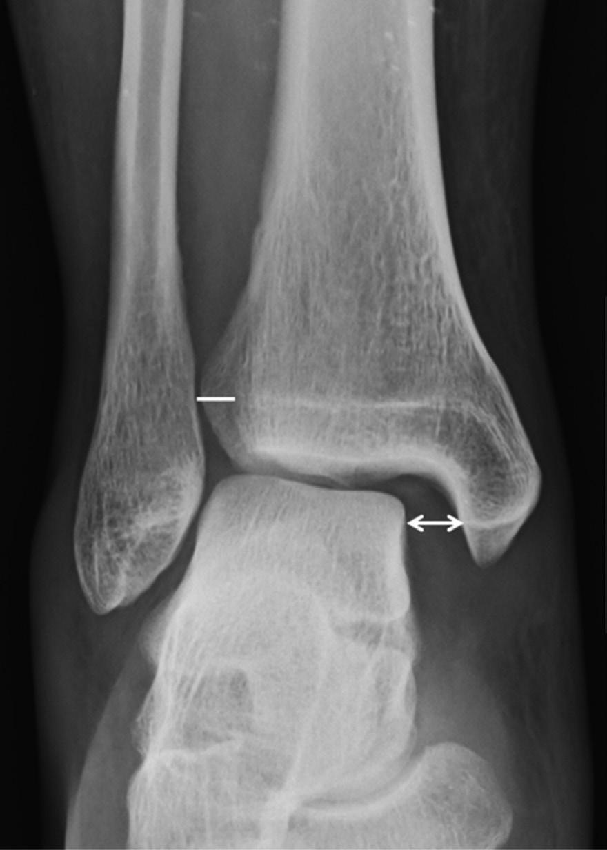 근골격방사선영상의빠르고쉬운판독 : 하지 Fig. 24. nkle joint fracture: pronation external rotation.