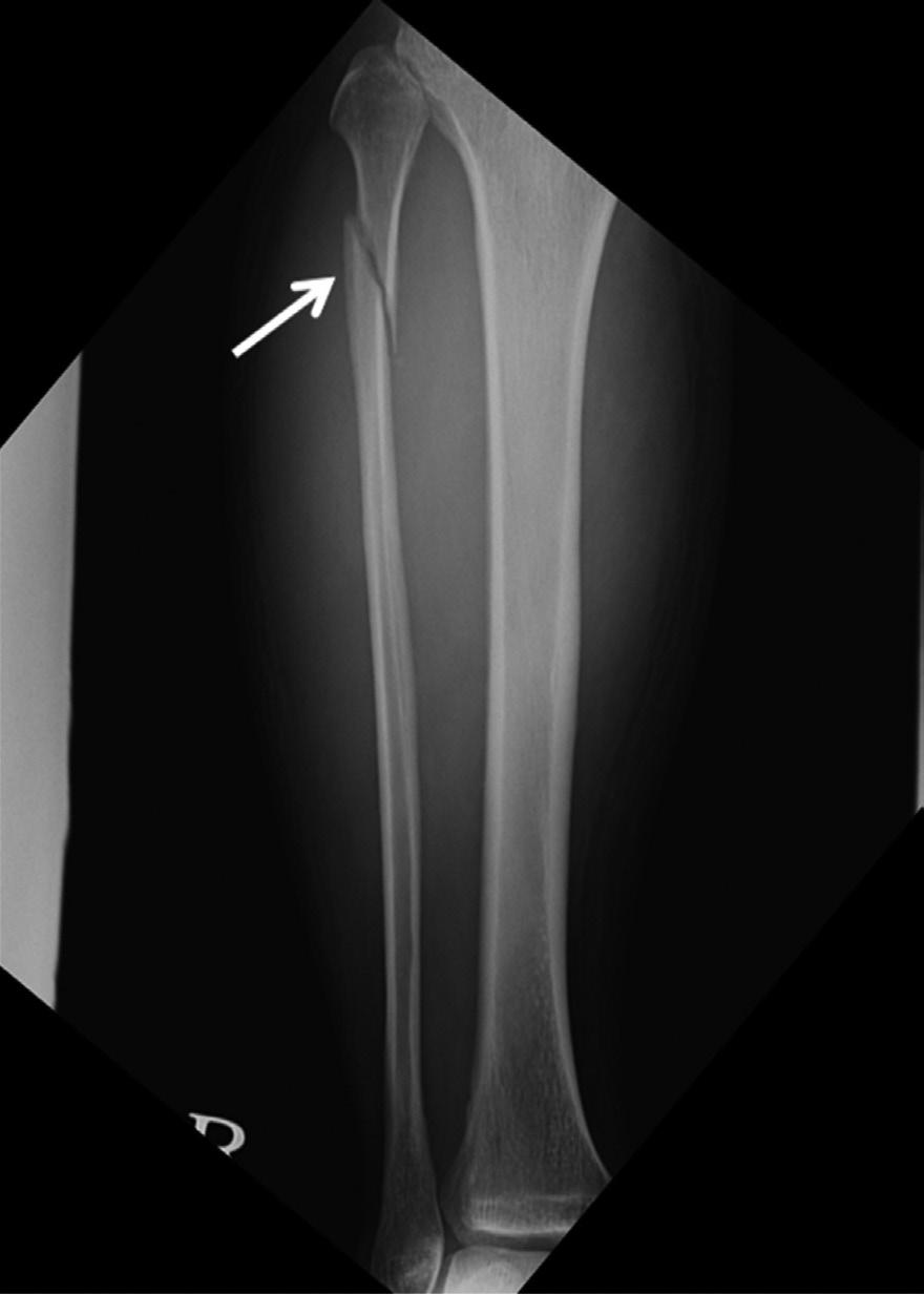 5 mm, and the distance between the lateral border of the tibia and the medial border of the fibula (tibiofibular overlap, white line) is 6.3 mm on the ankle P radiograph.