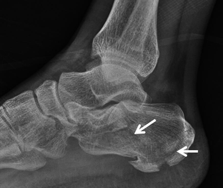 한석외 Fig. 25. Calcaneal complex fracture. There is a calcaneal complex fracture (arrows) on the () lateral radiograph and () computed tomography sagittal reformation image.