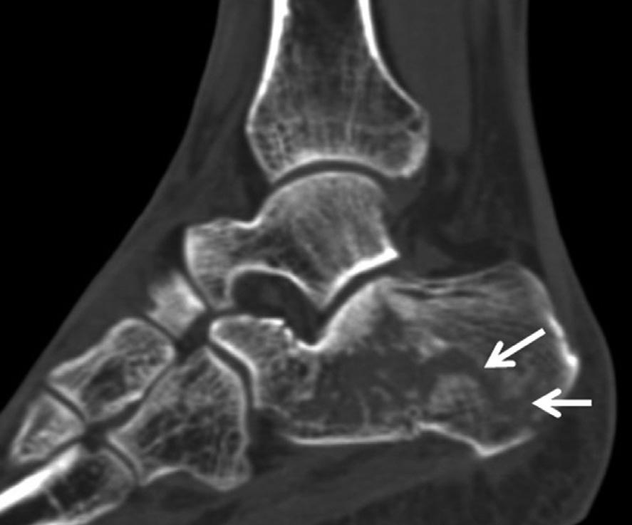 두번째중족골부터다섯번째중족골은외측으로전위되고, 첫번째중족골은내측으로전위된다. 중족골또는입방골 (cuboid bone) 의골절이함께발생할수있다 (53). Fig. 26. Calcaneal stress fracture.