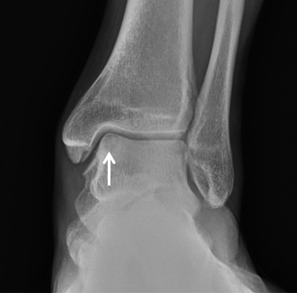 근골격방사선영상의빠르고쉬운판독 : 하지 Fig. 27. Osteochondral lesion of the talus.