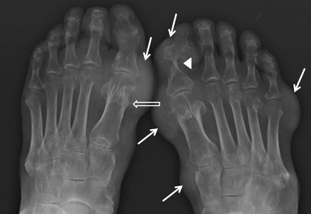 근골격방사선영상의빠르고쉬운판독 : 하지 Fig. 31. Gout. There are several soft tissue opacities (arrows) on the medial and lateral aspects of bilateral feet.