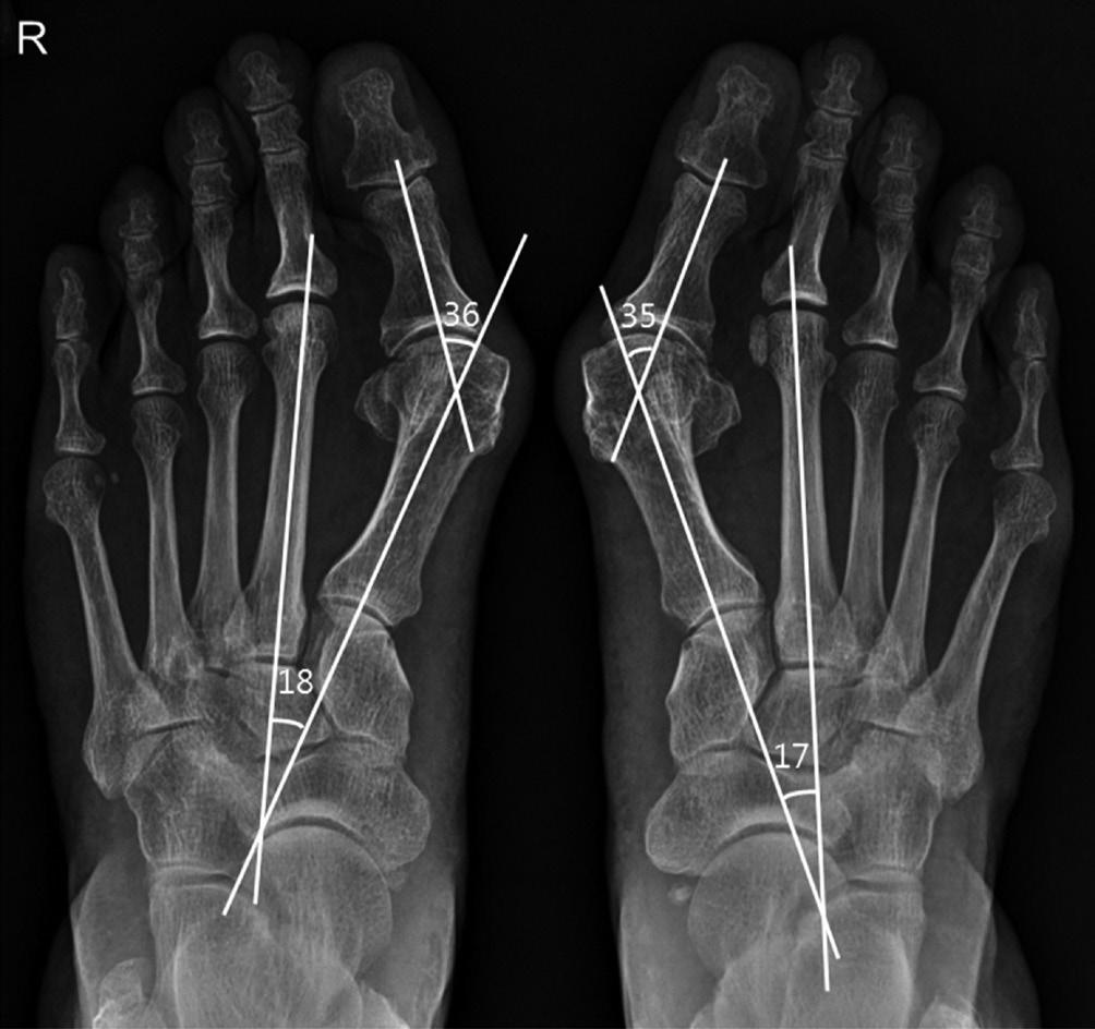 The characteristic overhanging edge (hollow arrow) is seen on the medial aspect of the left 1st metatarsal head. Fig. 30. Hallux valgus.