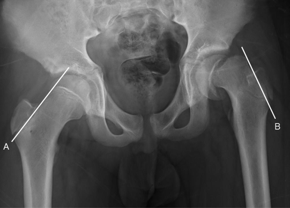 근골격방사선영상의빠르고쉬운판독 : 하지 Fig. 8. Legg-Calvé-Perthes disease.. Sclerosis of the proximal epiphysis of the left femur is seen on the P radiograph.