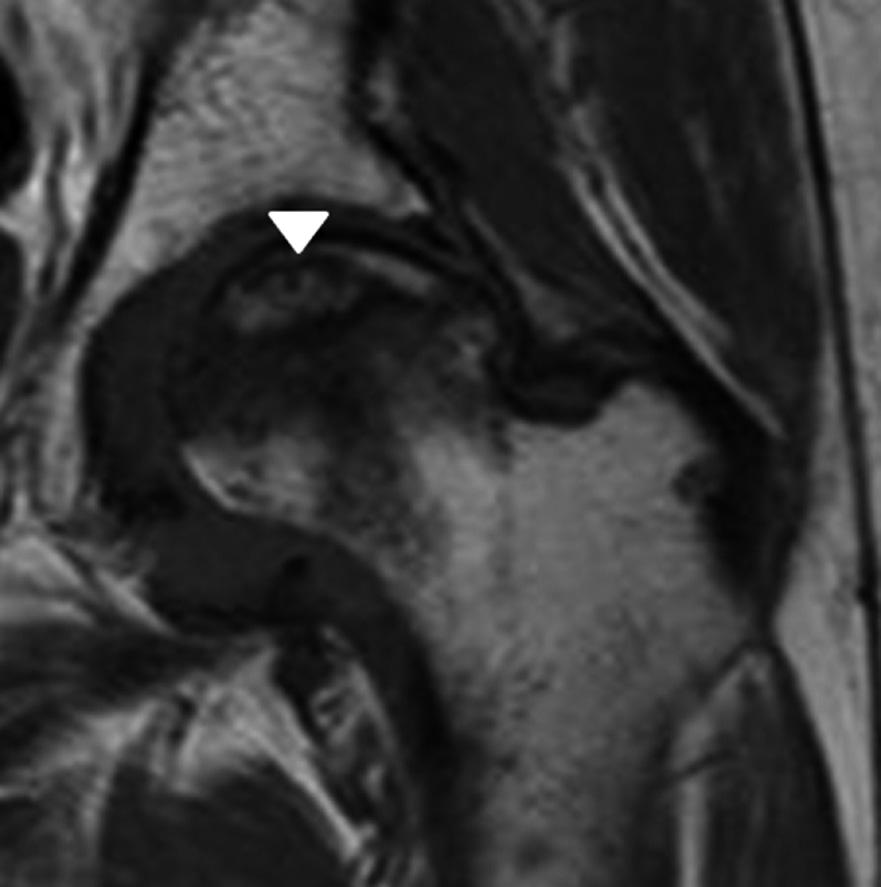 Pincer 형대퇴비구충돌증후군은 비구가과성장하여비구와대퇴골두-경부접합부간비정상인접촉이일어나발생한다.