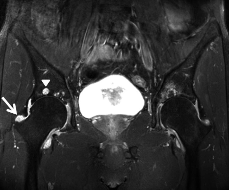 . Flattening of the femoral head and low signal intensity caused by bone marrow edema are observed on T1-weighted coronal magnetic resonance image.