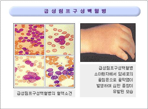 급성림프구성백혈병 : 조기검진 피로 체중감소 발열과감염증상 일반적인혈액검사 : - 빈혈 - 백혈구이상