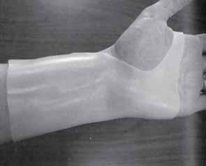 나 ) 주관절에대한보조기 - Elbow control orthosis : 주관절조절보조기 - Rigid elbow orthosis : 경성주관절조절보조기 - Dorsal elbow extensor orthosis :