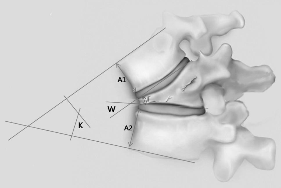 Thoracolumbar spine fracture, Posterior ligament complex 학적분석은 student t-test (SPSS 1 for Window, Chicago, IL) 로하였으며, 유의도.5 이하인경우를통계학적의의가있는것으로판단하였다. 결 과 1. 일반적결과 압박골절 22 례, 방출성골절 18 례이었다.