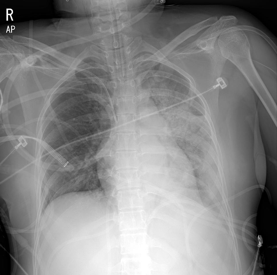 44 Anesth Pain Med Vol. 12, No. 1, 2017 Fig. 2. Chest radiograph after surgery shows diffuse increased opacity in left lung. 여폐기능관리를위해기계환기를유지하기로결정하였고환자는기관내튜브를유지한상태로중환자실로이송되었다.
