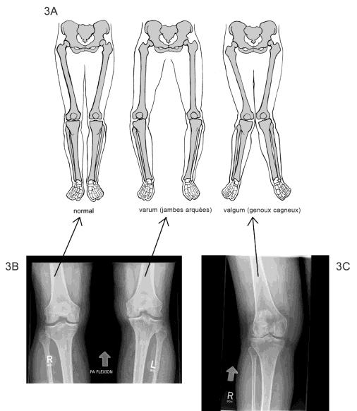 보다작을때발생 ( 정상 170-175 도 ) 정면에서보면 X 자모양의다리 심하면보행시무릎이닿아다리를벌리고걷는다. 가쪽곁인대가짧아지고안쪽곁인대가늘어난다.