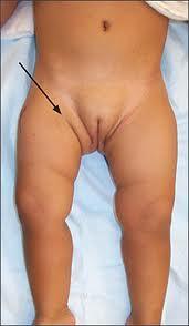 Congenital Dislocation of hip 현재에는발달성엉덩관절형성이상 (developmental dysplasia of