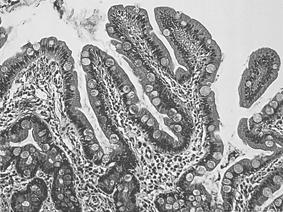 -Cheol Ju Park, et al : Echinostoma hortense infection diagnosed by endoscopy - Figure 2.